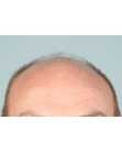 Before Hair Transplant &nbsp;2 Sessions (Areas)